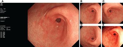 Deep learning-assisted diagnosis of chronic atrophic gastritis in endoscopy